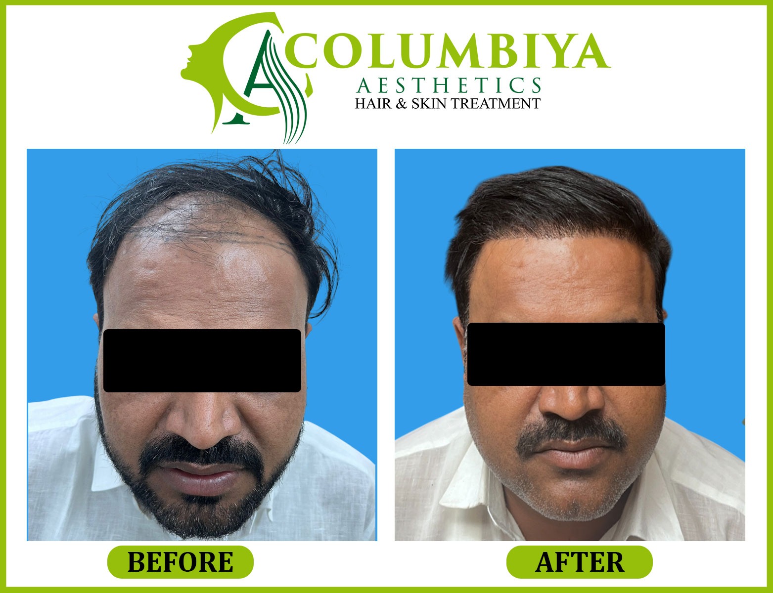 Scalp Result