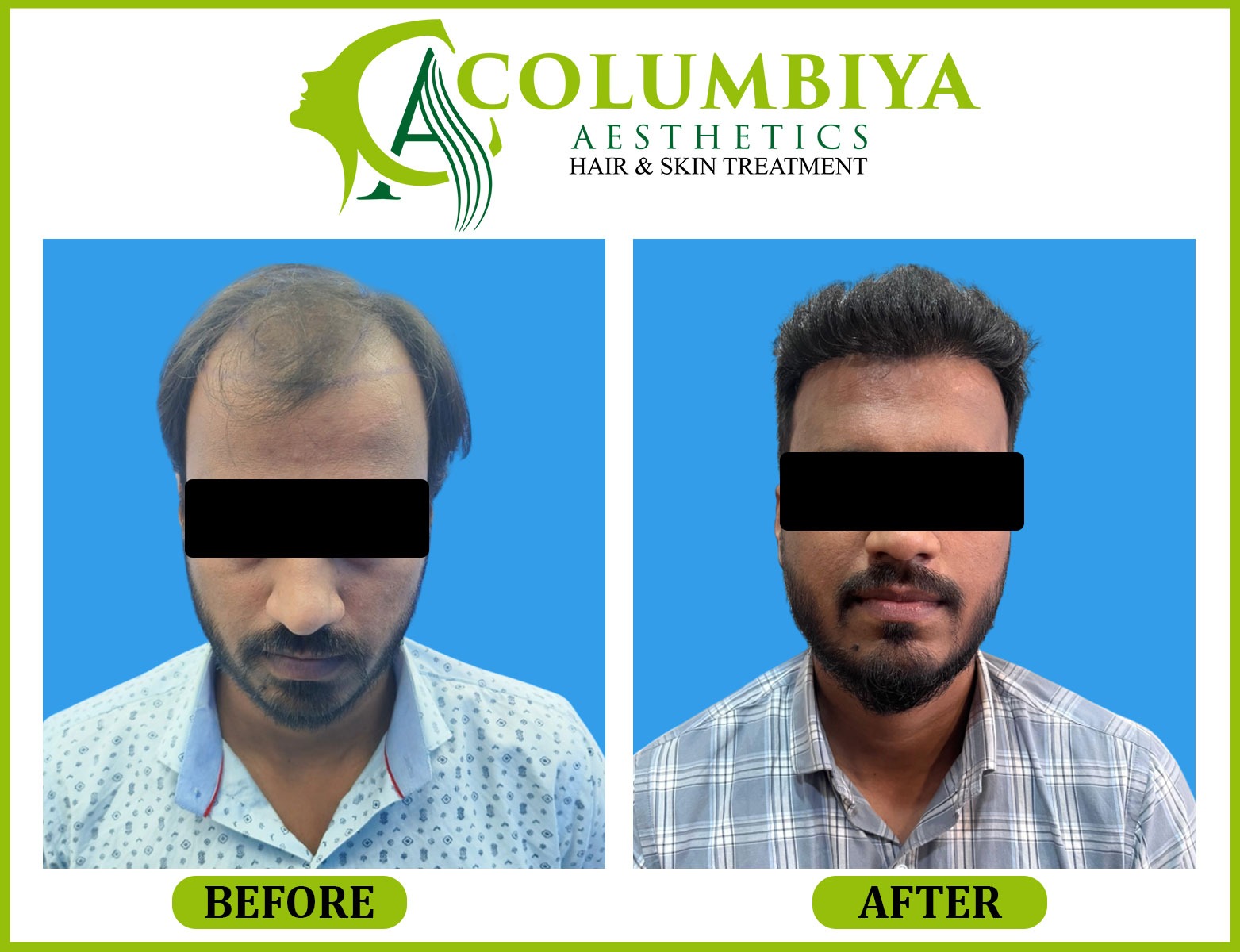 Scalp Result