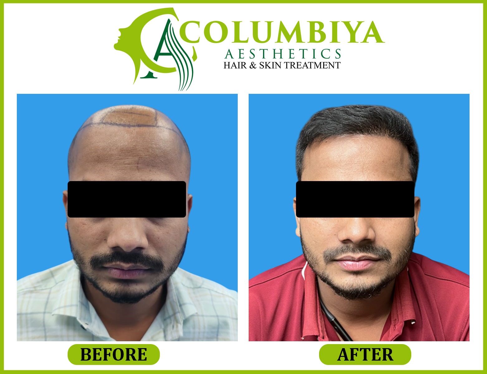 Scalp Result