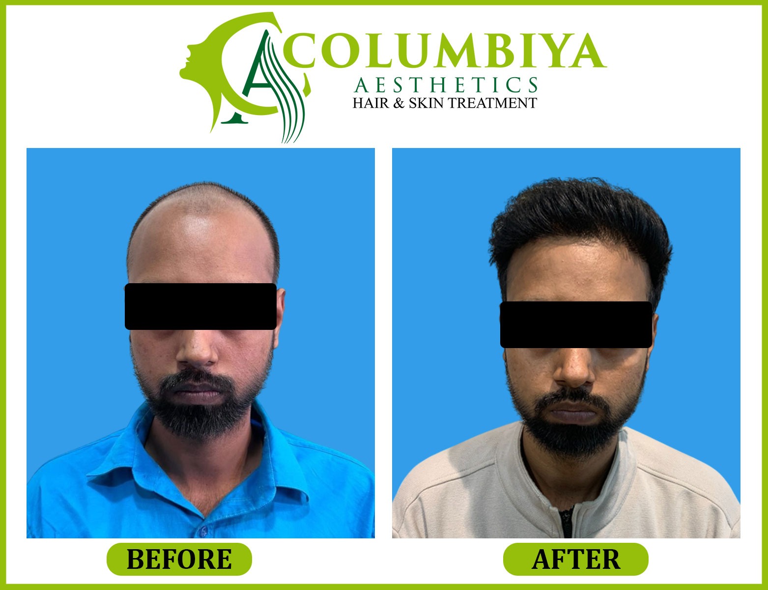 Scalp Result