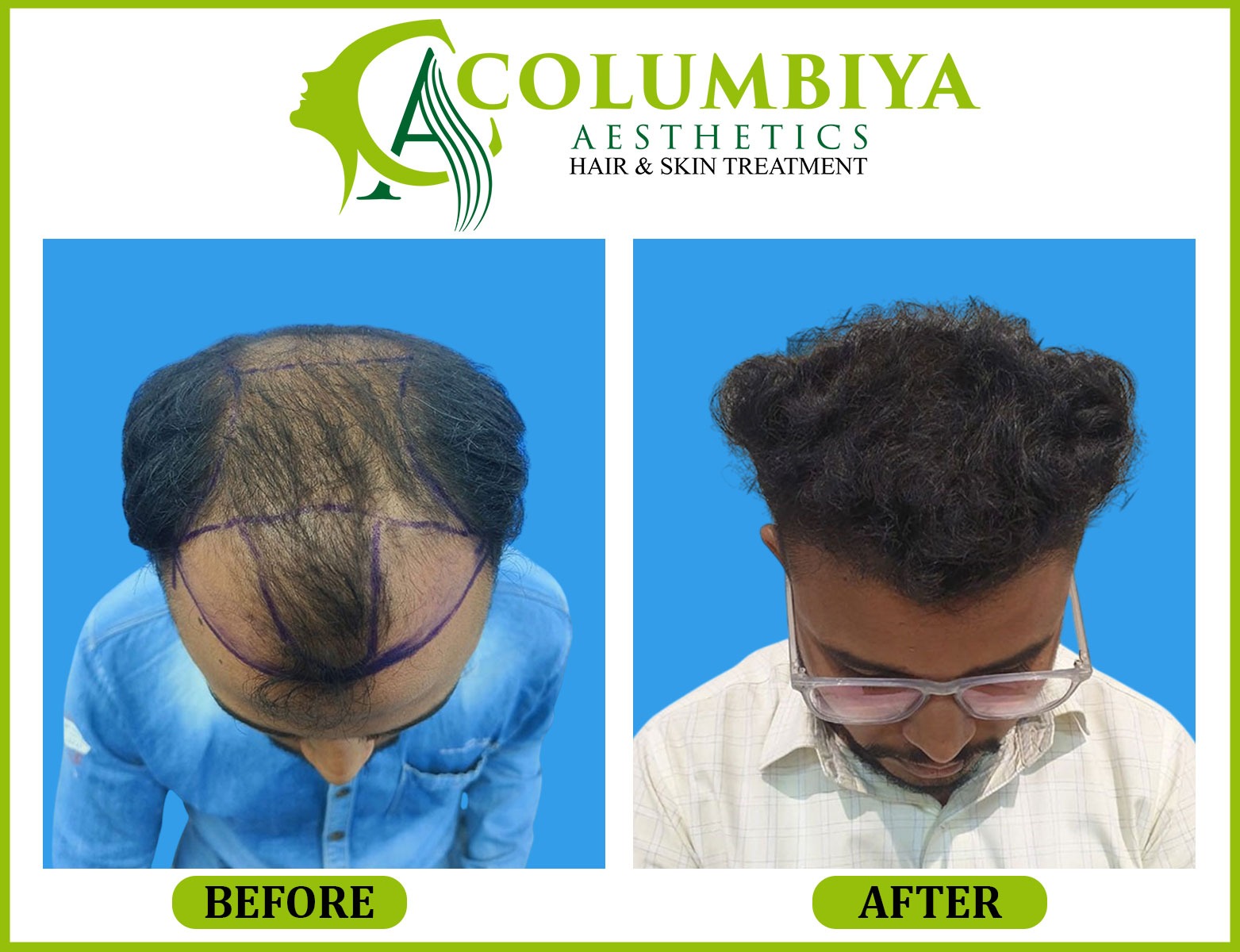 Scalp Result