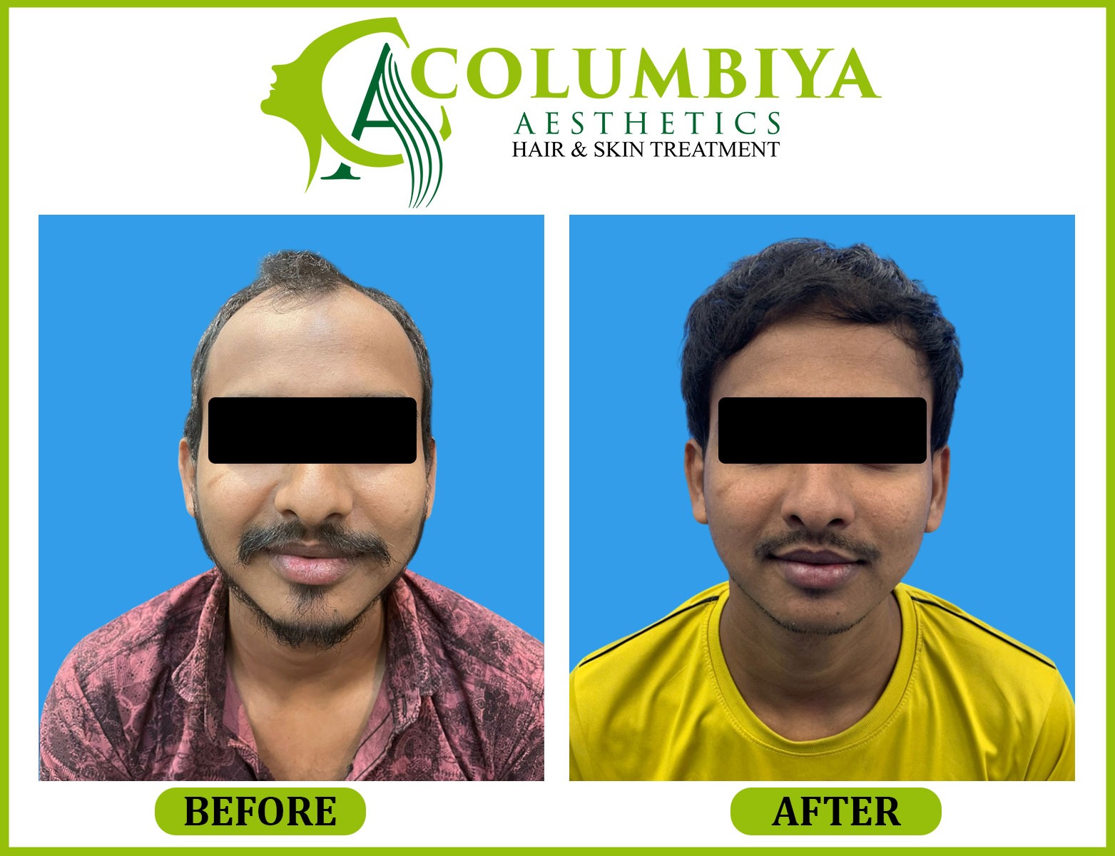 Scalp Result