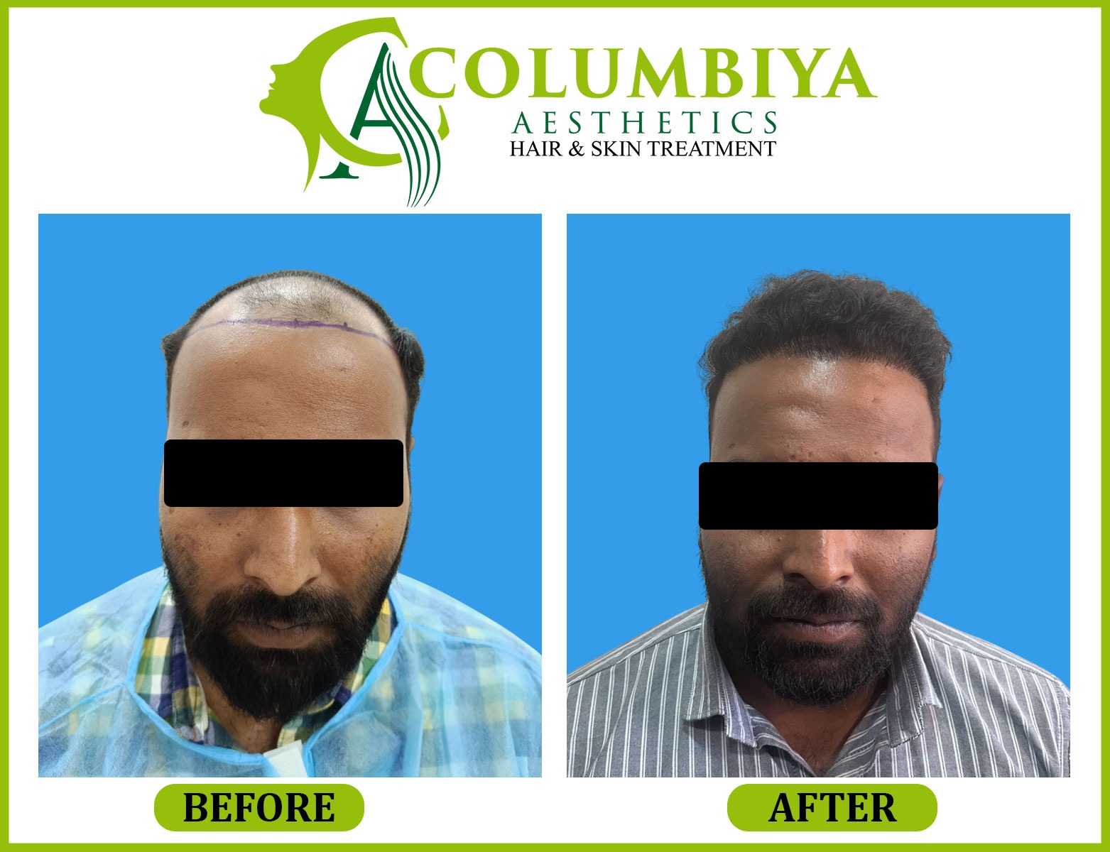 Scalp Result