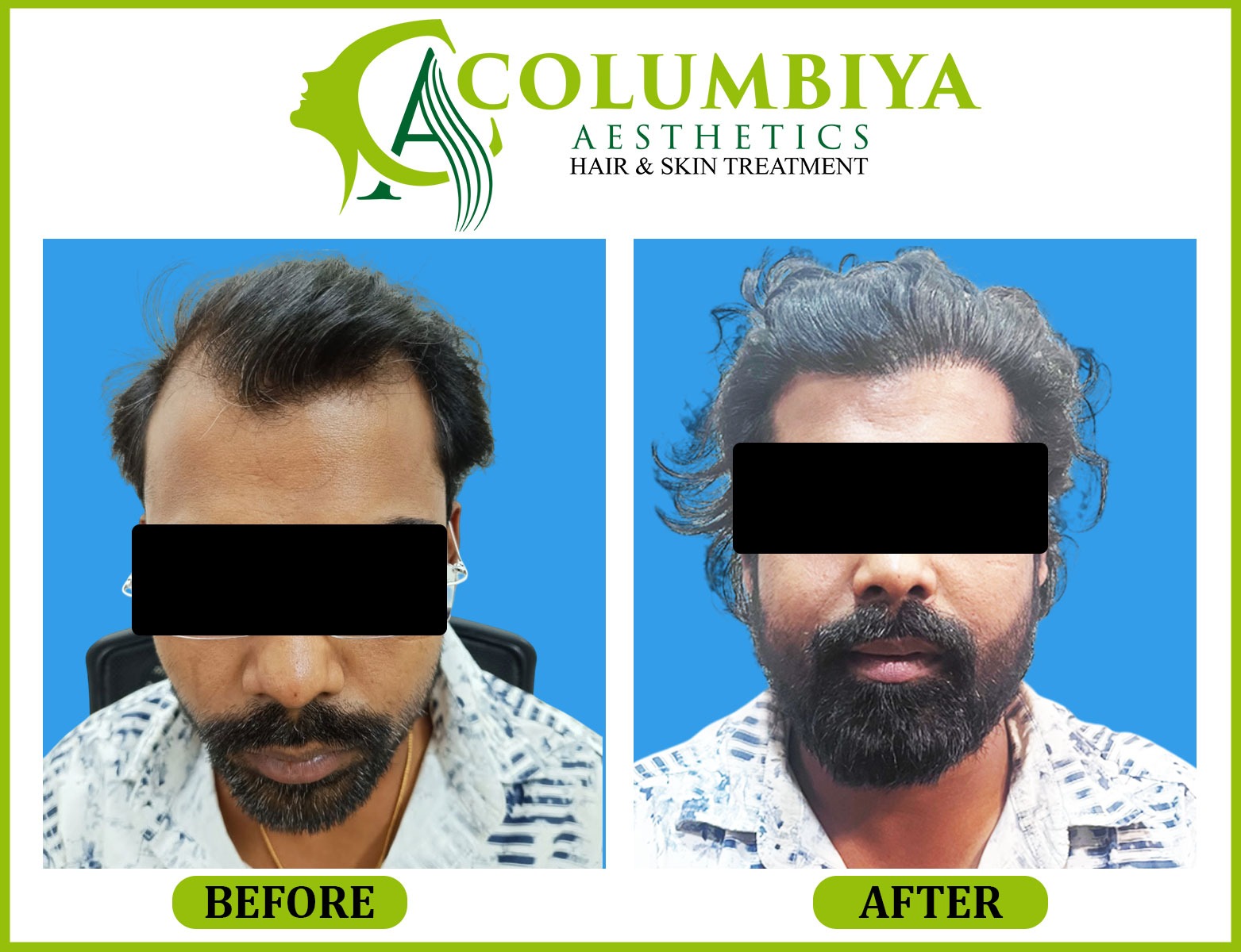 Scalp Result