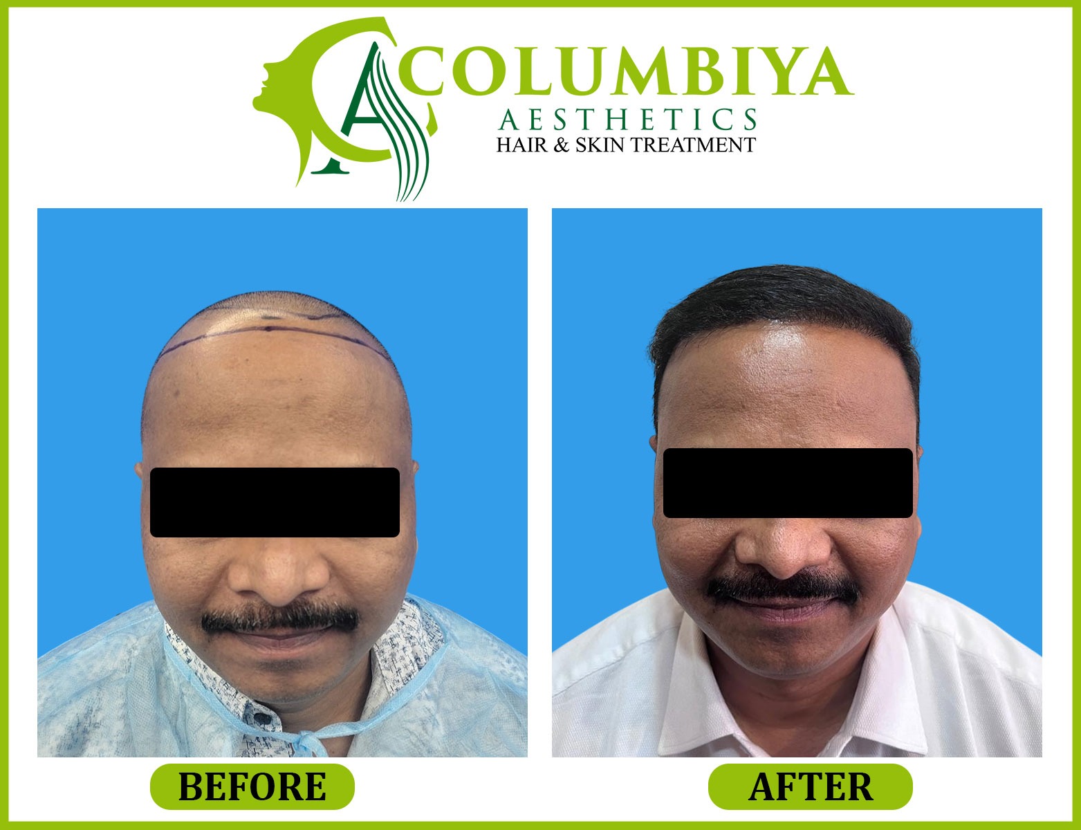 Scalp Result